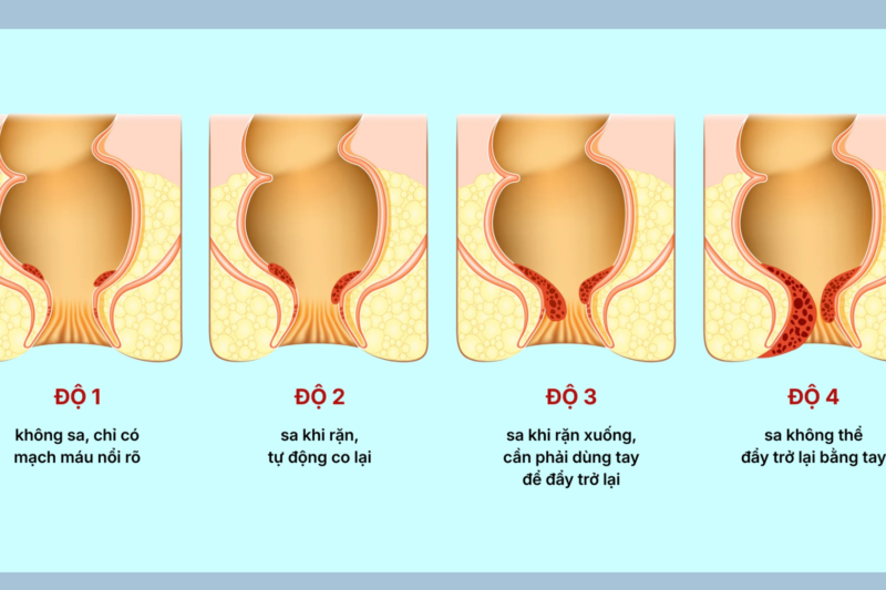 Điều trị trĩ ngoại: Phương pháp an toàn và hiệu quả hiện nay