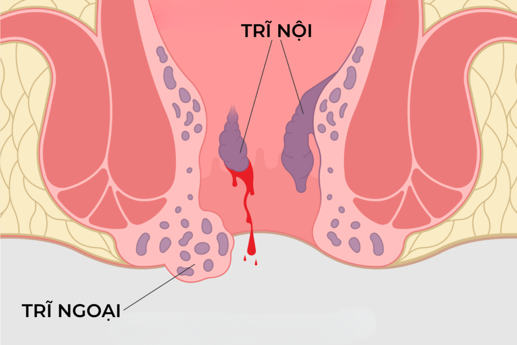 Điều trị trĩ ngoại hiệu quả: Y khoa và tại nhà giúp giảm đau, hỗ trợ thu nhỏ búi trĩ 
