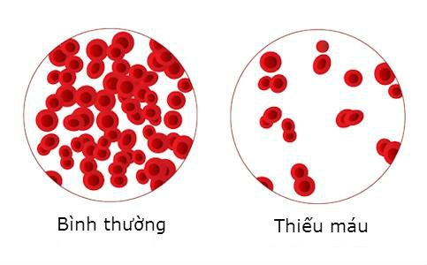 Cảnh báo: Bệnh trĩ chảy máu và những biến chứng nguy hiểm 
