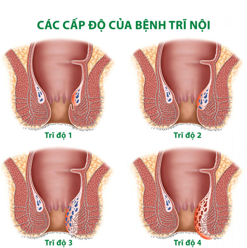 Cách điều trị trĩ nội độ 1, 2, 3 như thế nào? 7 phương pháp hỗ trợ cải thiện theo từng giai đoạn