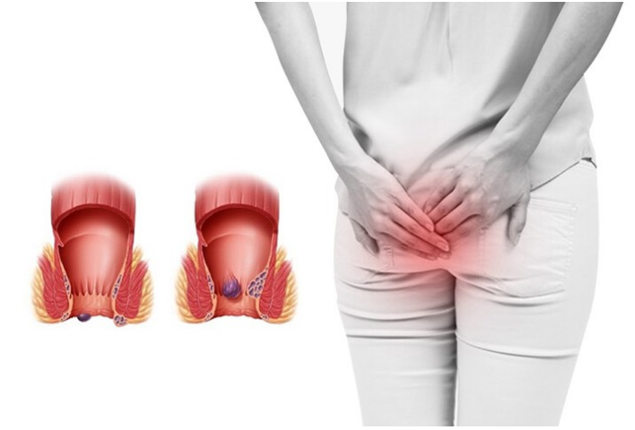 Phương pháp chữa bệnh trĩ hiệu quả: Hướng điều trị giảm đau, giảm sa búi trĩ theo từng cấp độ 