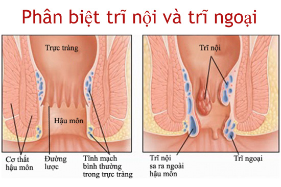 Tại sao trĩ nội và trĩ ngoại khác nhau? Chuyên gia giải đáp cách phân biệt và hướng điều trị 
