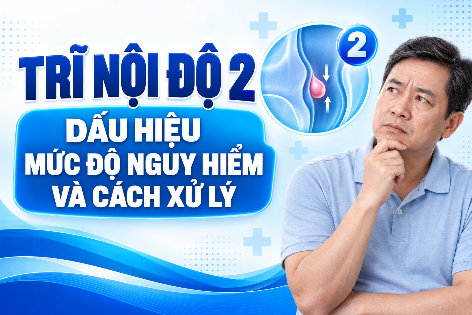 Trĩ nội độ 2: Dấu hiệu, mức độ nguy hiểm và cách xử lý