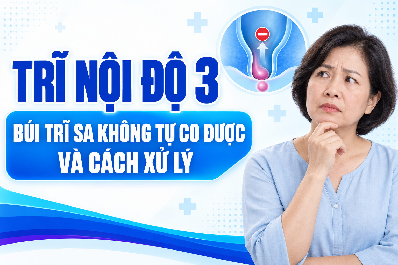 Trĩ nội độ 3: Búi trĩ sa không tự co được và cách xử lý